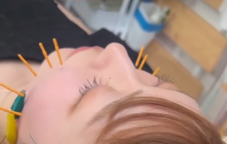 施術の写真
